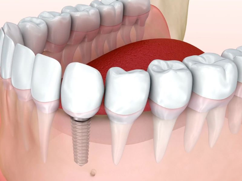 Ugradnja implantata nije bolna, vraća funkciju žvakanja, osmeh i samopouzdanje.